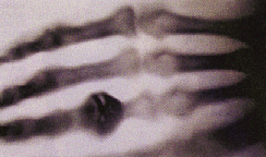 The first X-ray picture of a hand