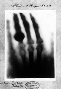 Mrs. Rontgen's hand X-ray